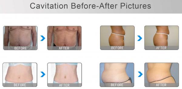 Effective fat reducer!!!! best rf vacuum cavitation slimming machine body reduction treatments