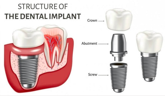 Duable Dental Implant Screw Set Titanium Medical Screw