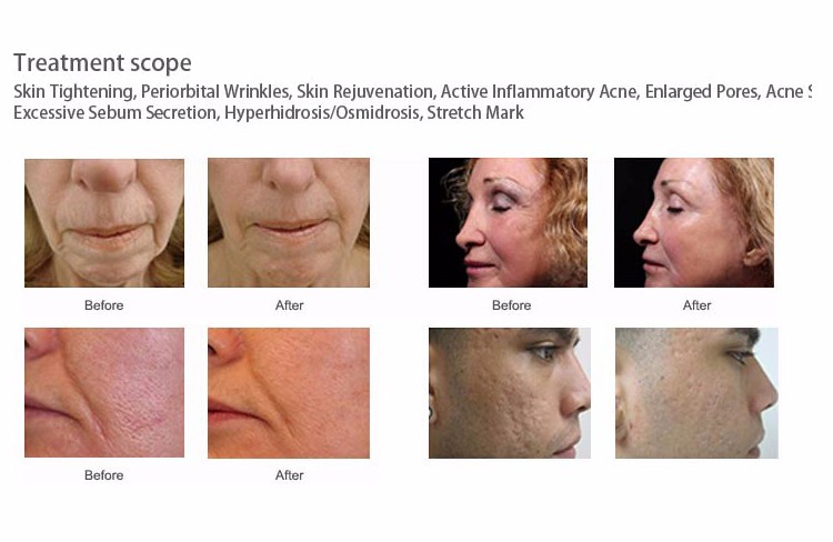 FDA technology rf fractional rf stretch mark removal microneedle machine