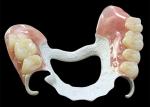 Customized Partial Removable Denture with High-Performance Polymer (HPP)
