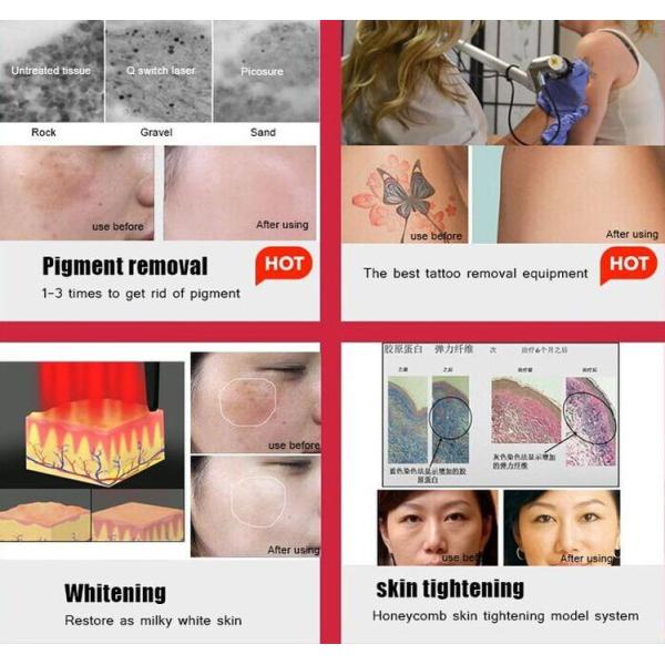 755nm 532nm picolaser Laser Tattoo Removal Machine 1064nm Microdermabrasion Device