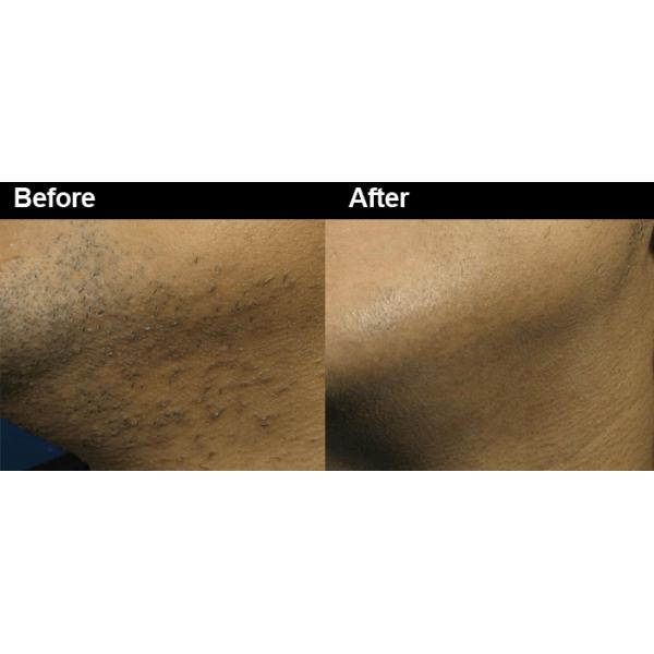 Solid State Laser Hair And Tattoo Removal Machine , Industrial Laser Hair Removal Machine