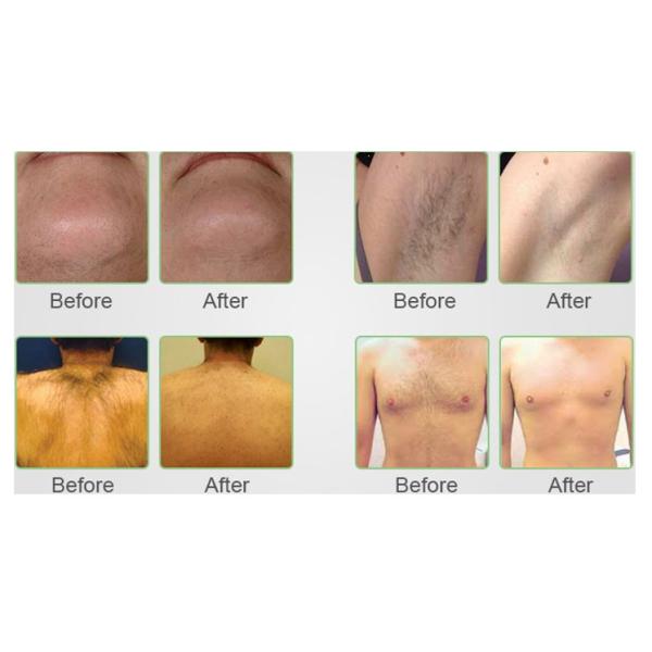 SDL-D 1300VA Full Body Laser Hair Removal Machine For Female 5ms-400ms