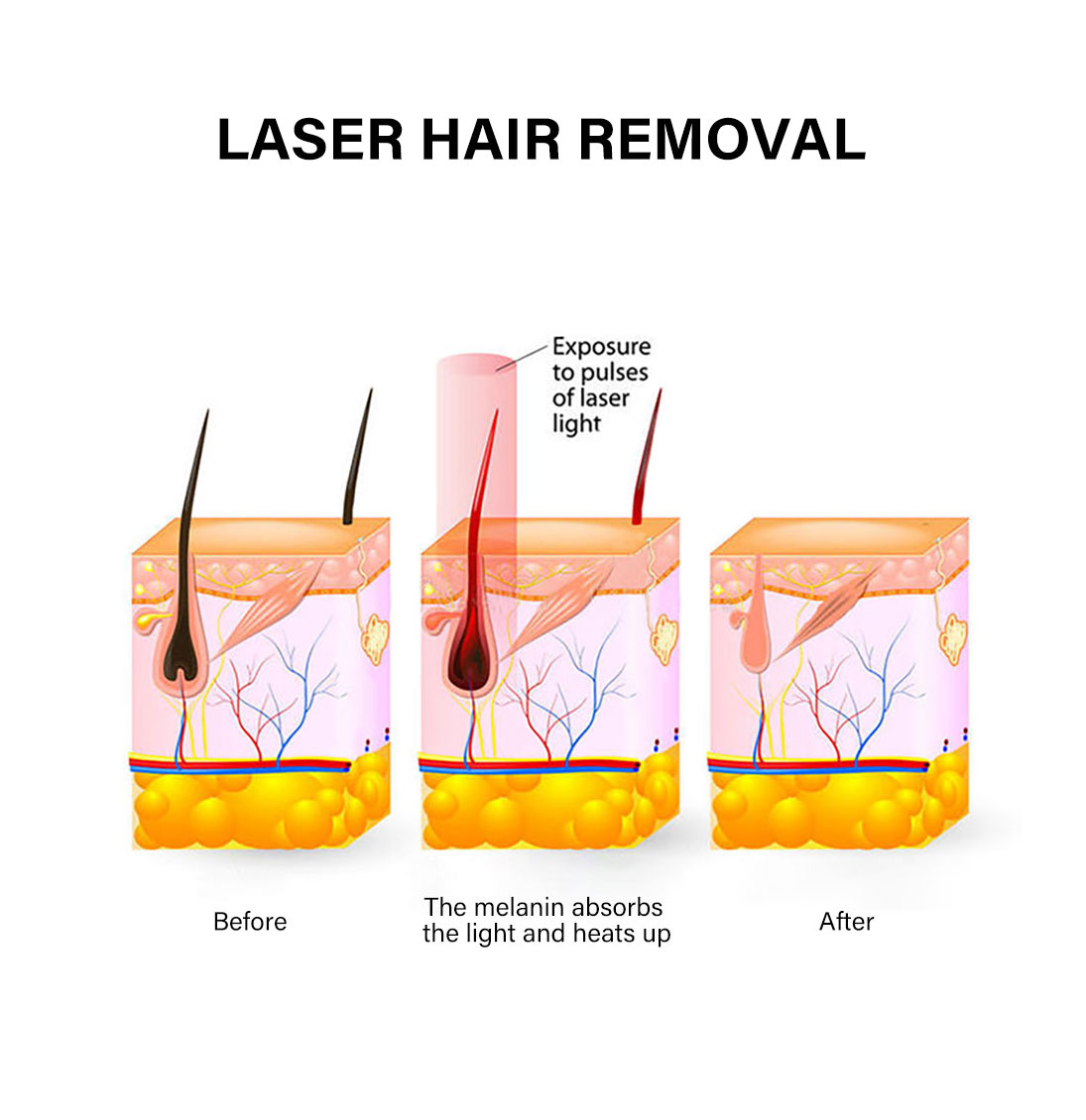 Lightweight Fiber Laser Hair Removal Machine Portable Permanent Hair Removal System