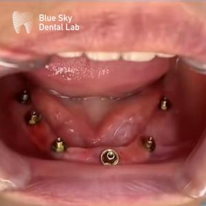 Nature Design Dental Implant Case Implant Operation Cases For Multiple Choices