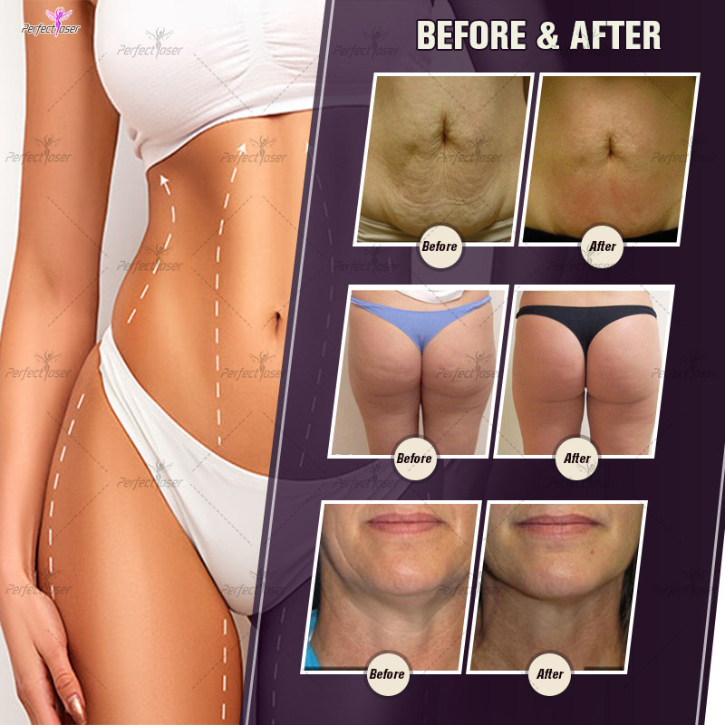Roller Slimming Machine 5 Technology Cavitation Skin Lifting RF Machine