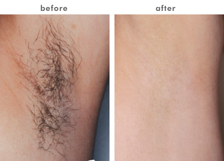 Real Sapphire Probe Ipl Shr Hair Removal Machine 8 * 40mm Spot Size 530nm 640nm