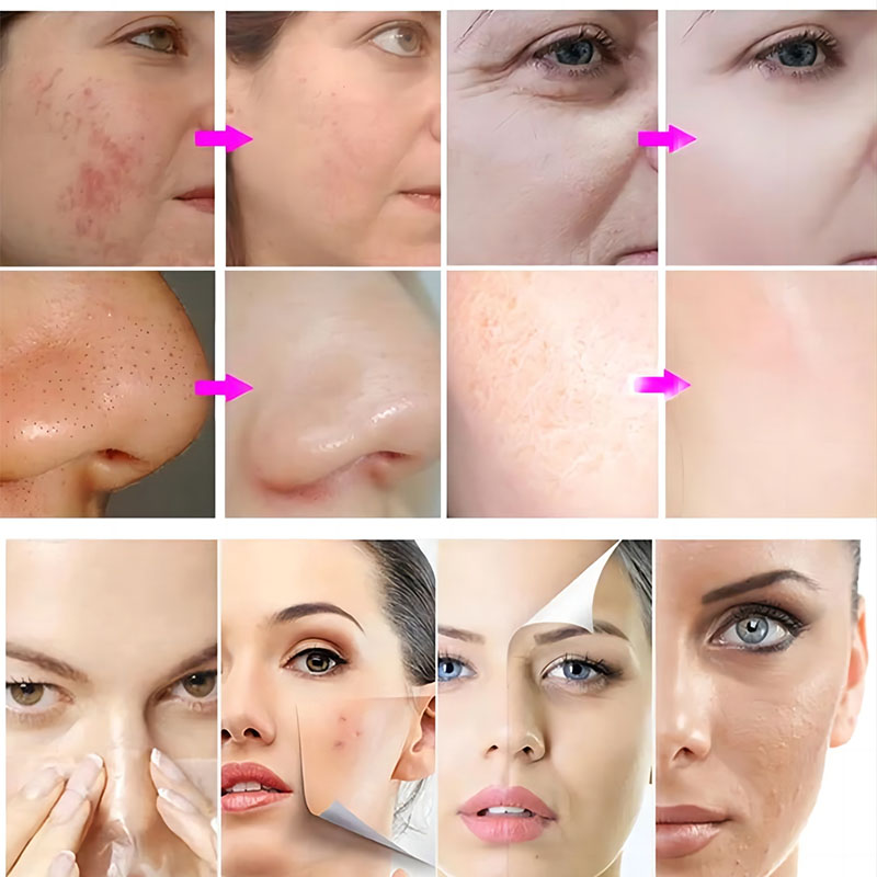 Effortless 14 In 1 Hydrafacial Machine For Wrinkle Remove And Skin Rejuvenation