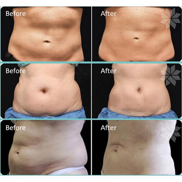 Cryolipolysis slimming machine 4handls