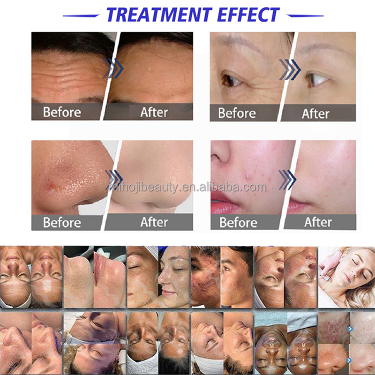 Effortless 14 In 1 Hydrafacial Machine For Wrinkle Remove And Skin Rejuvenation