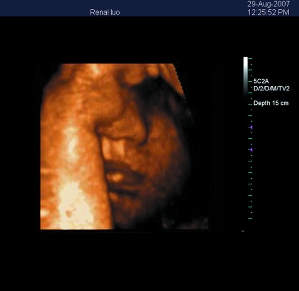 Portable 3D Ultrasound Machine Color Doppler Ultrasound Scanner with 15 Inch LED Screen