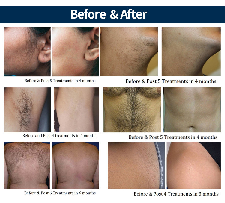 50kg OEM 808nm Diode Laser Hair Removal 1-10hz Frequency