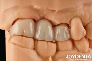 Experience Color Realistic Full Zirconia With High Resistance To Staining And Flexural Strength Of 1000 MPa