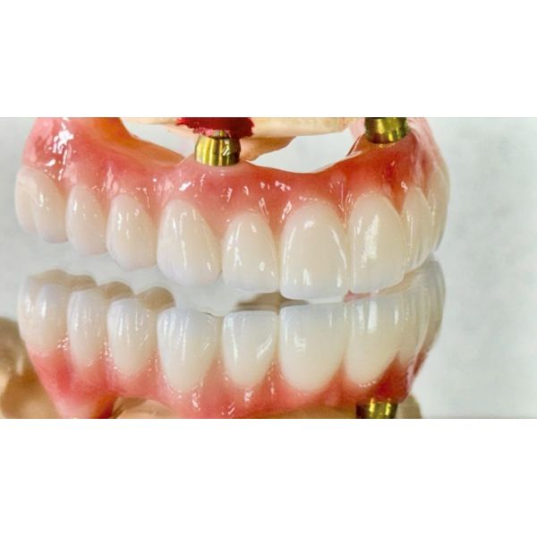 Dental All On X Implant PFM Crown Titanium Fixed Hybrid Denture
