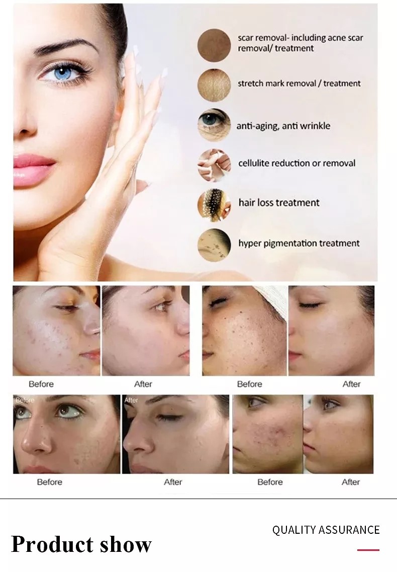 Professional Microneedling Pen - Wireless Derma Auto Pen - Best Skin Care Tool Kit for Face and Body