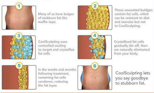 2500W high power -15°C CE approval 4 handles double chin vacuum cool body sculpting cryolipolysis machine