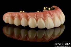 Custom-made For Each Patient Ti-Bar Zirconia Hybrid Bridge For Long-lasting Dental Prosthesis