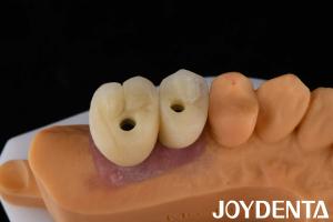 Porcelain Implant Crown and Bridge The Ultimate Solution for Restoration Of Missing Teeth