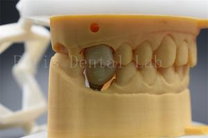 China Customizable Dental Implant Abutment Crown Comfortable For Patients wholesale