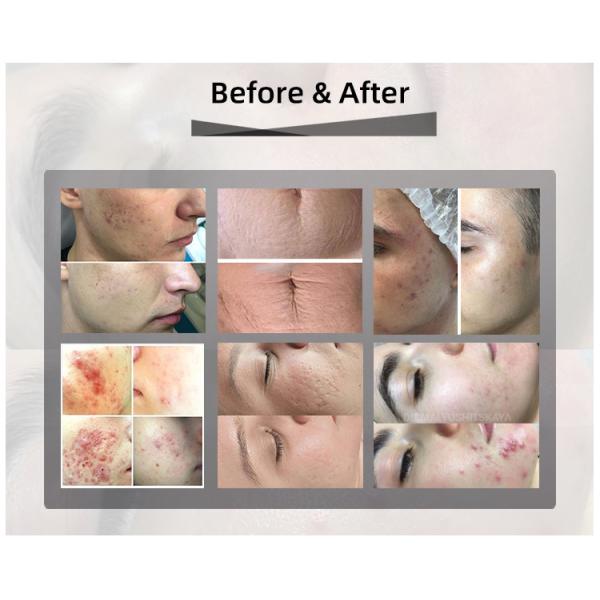 Acne Stretch Marks Co2 Fractional Laser Machine ODM OEM