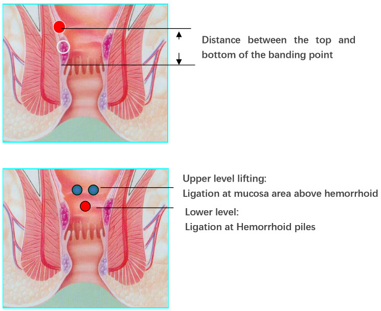 Tighter Binding Disposable Hemorrhoid Ligator With Anoscope New Silica Gel Material