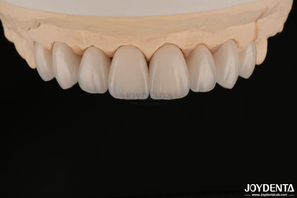 Quality Smooth And Lightweight Dental Veneers Biocompatible And Comfortable For Oral Health for sale