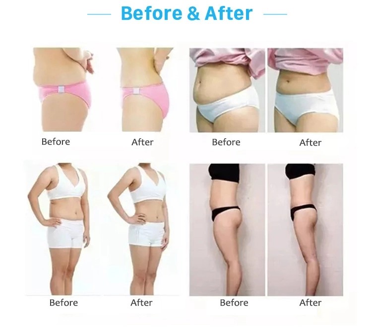 radio frequency device Vacuum liposuction sliming machine shape beauty machine Vacuum roller vela slim