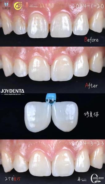 Quality Anterior Tooth Indication Dental Veneers With No Preparation Needed And No Discoloration for sale