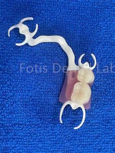 China Customizable Comfortable Removable Partial Denture For Stable Teeth Replacement wholesale