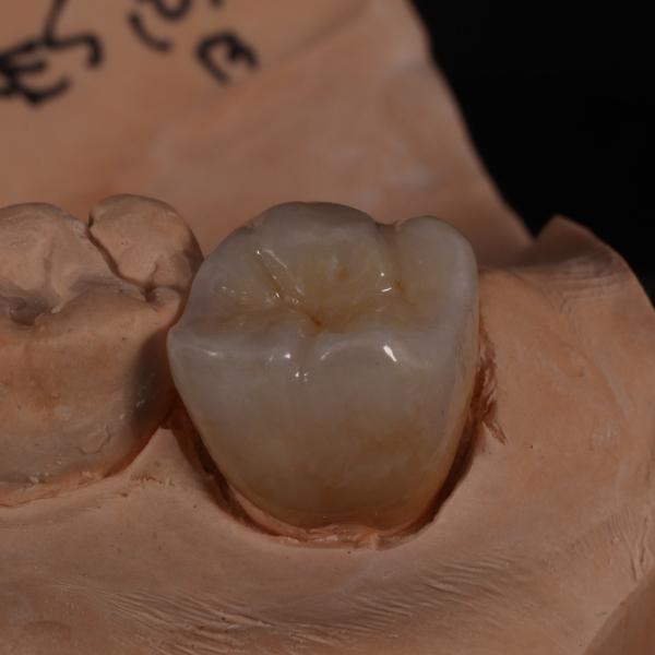 Quality Full Contour Translucent Zirconia Crown for Aesthetically Pleasing Results for sale