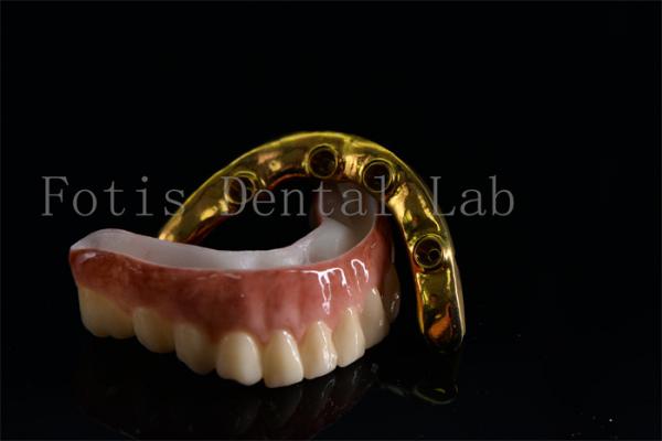 Quality Affordable All On Six Dental Implants Effective Treatment Easy To Clean for sale
