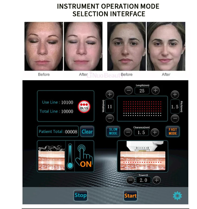 12D HIFU Beauty Machine With Ice Compress For Skin Tightening And Face Lifting