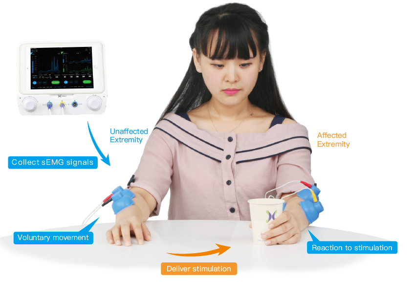 High Efficiency Emg Triggered Electrical Stimulation Device With Restore Nerve Function