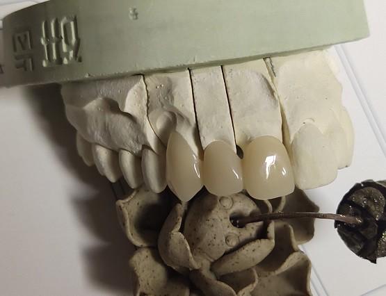 Quality CAD Technique ISO13485 Interim Crown for sale