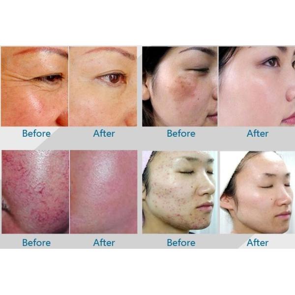4 ColorLED Phototherapy Machine For Decrease Spider Veins / Broken Capillaries