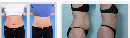 2 In 1 Non Surgical Liposuction Machine 980nm Lipolysis Laser Machine