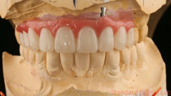 Quality Good Fitting Precise Esthetic Zirconia Porcelain Crown Pink Porcelian With Bleaching Shade for sale