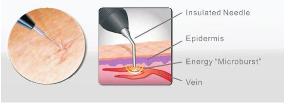 flat warts removal with good immediate results