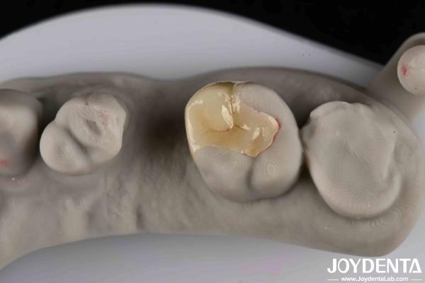 Quality Strong Resistance To Fracture Emax Inlay Onlay Natural-looking Esthetics And Durability for sale