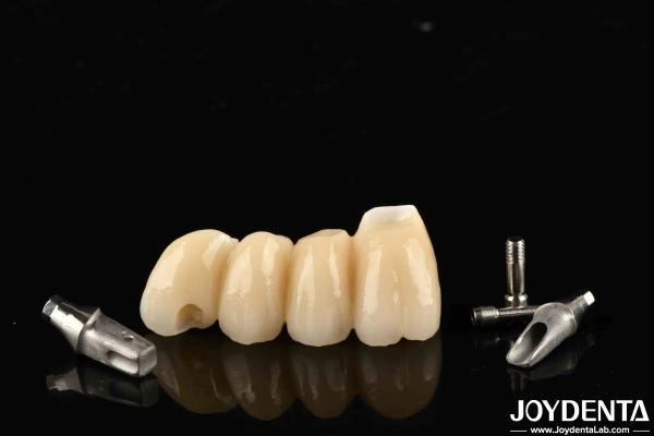 Quality Customizable Implant Crown And Bridge In Porcelain Precision For Perfect Function for sale