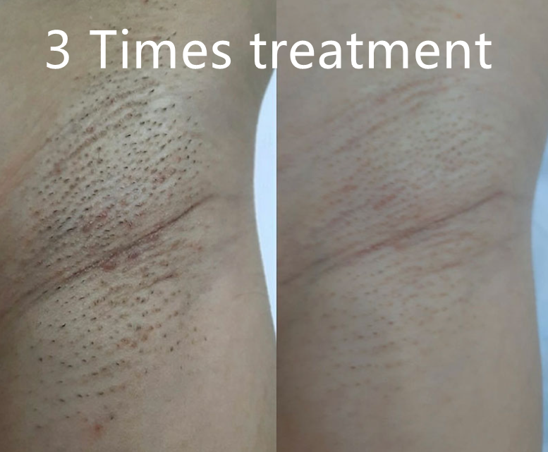 Lightweight Fiber Laser Hair Removal Machine Portable Permanent Hair Removal System