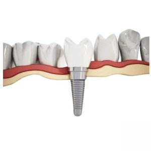 China Durable Titanium Dental Implant High Biocompatibility Corrosion Resistant wholesale
