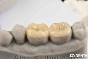 Emax Inlay Onlay Precise Fit And Hypoallergenic Biocompatibility Easy To Clean