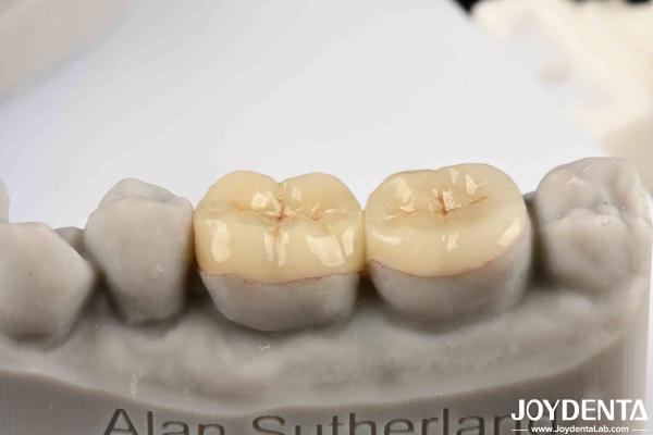 Quality Emax Inlay Onlay Precise Fit And Hypoallergenic Biocompatibility Easy To Clean for sale