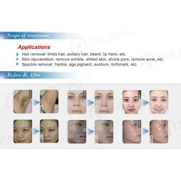 IPL treatment_.jpg