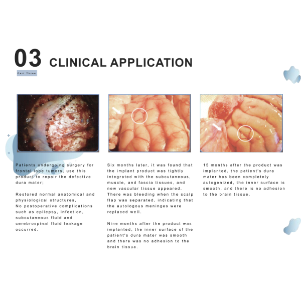 High Bionics Collagen Dura Substitute Tissue Regeneration