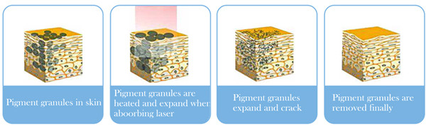Eliminink tattoo removal nd yag laser working principle q-switched laser for brown spots