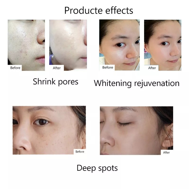 Professional Microneedling Pen - Wireless Derma Auto Pen - Best Skin Care Tool Kit for Face and Body