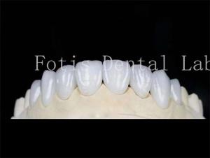 Natural Color Dental Laminate Veneers Fake Teeth Veneers With Bonding Cement