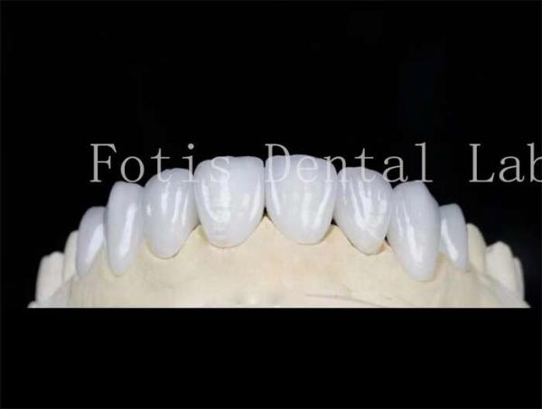 Quality Natural Color Dental Laminate Veneers Fake Teeth Veneers With Bonding Cement for sale
